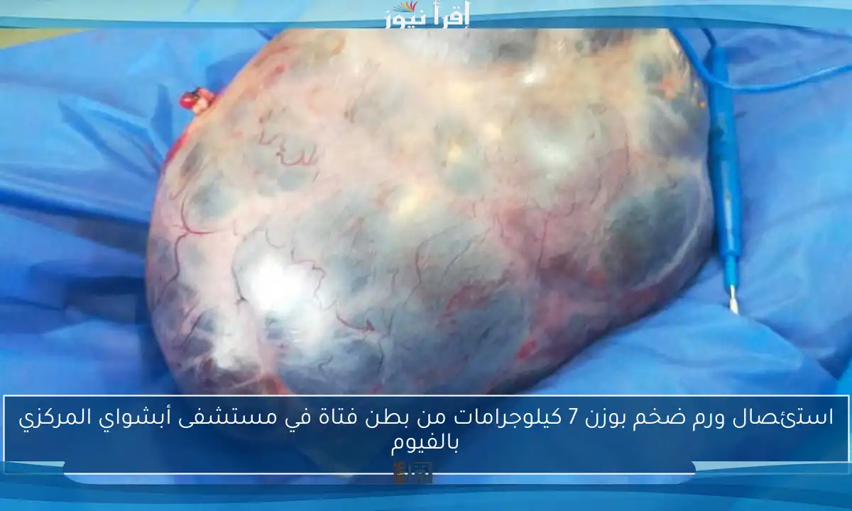 استئصال ورم ضخم بوزن 7 كيلوجرامات من بطن فتاة في مستشفى أبشواي المركزي بالفيوم